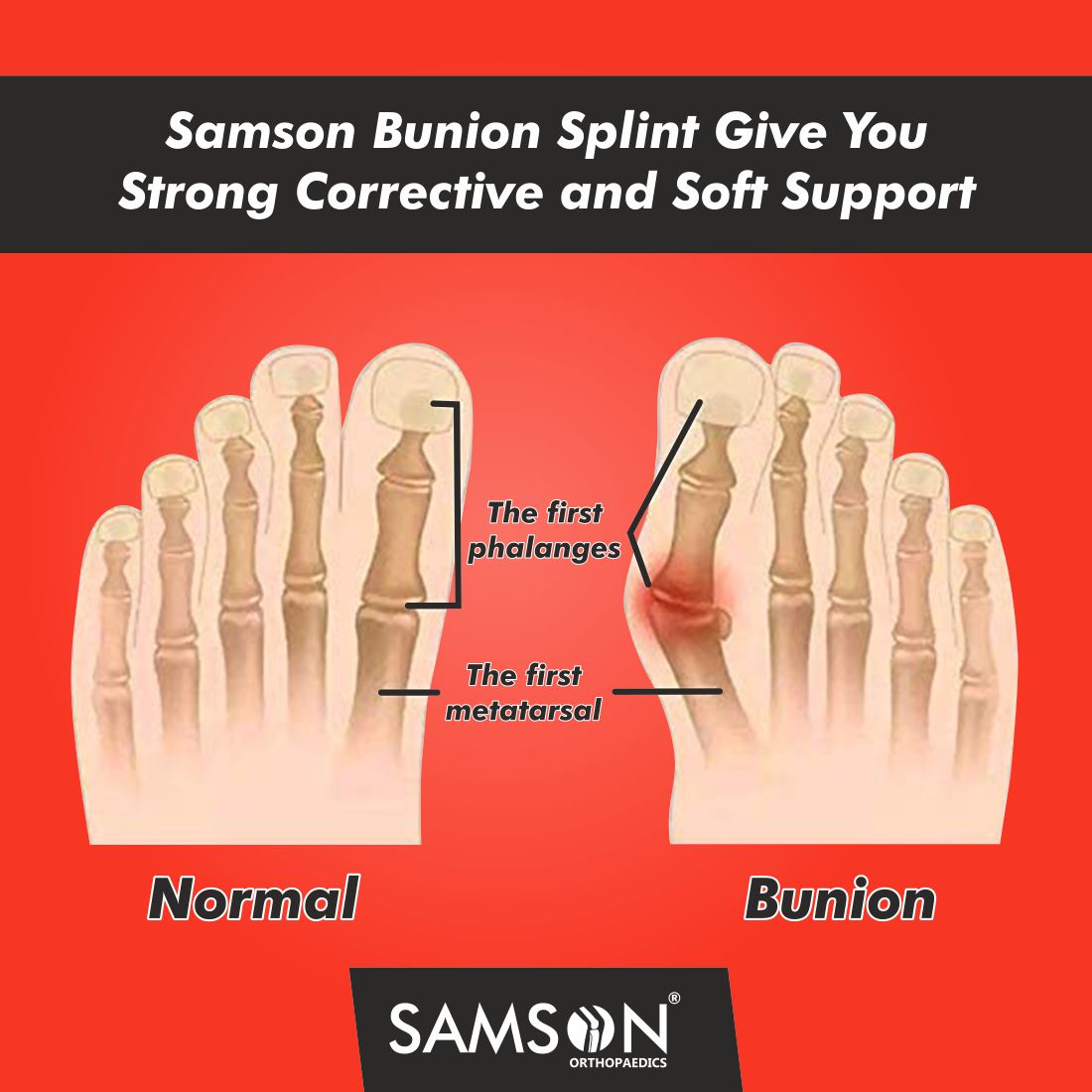 Bunion Splint