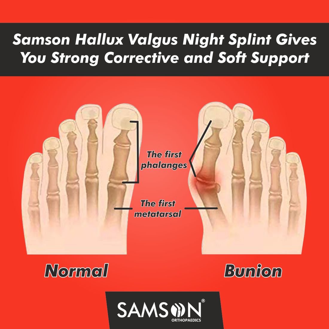 Hallux Valgus Night Splint (Pair)