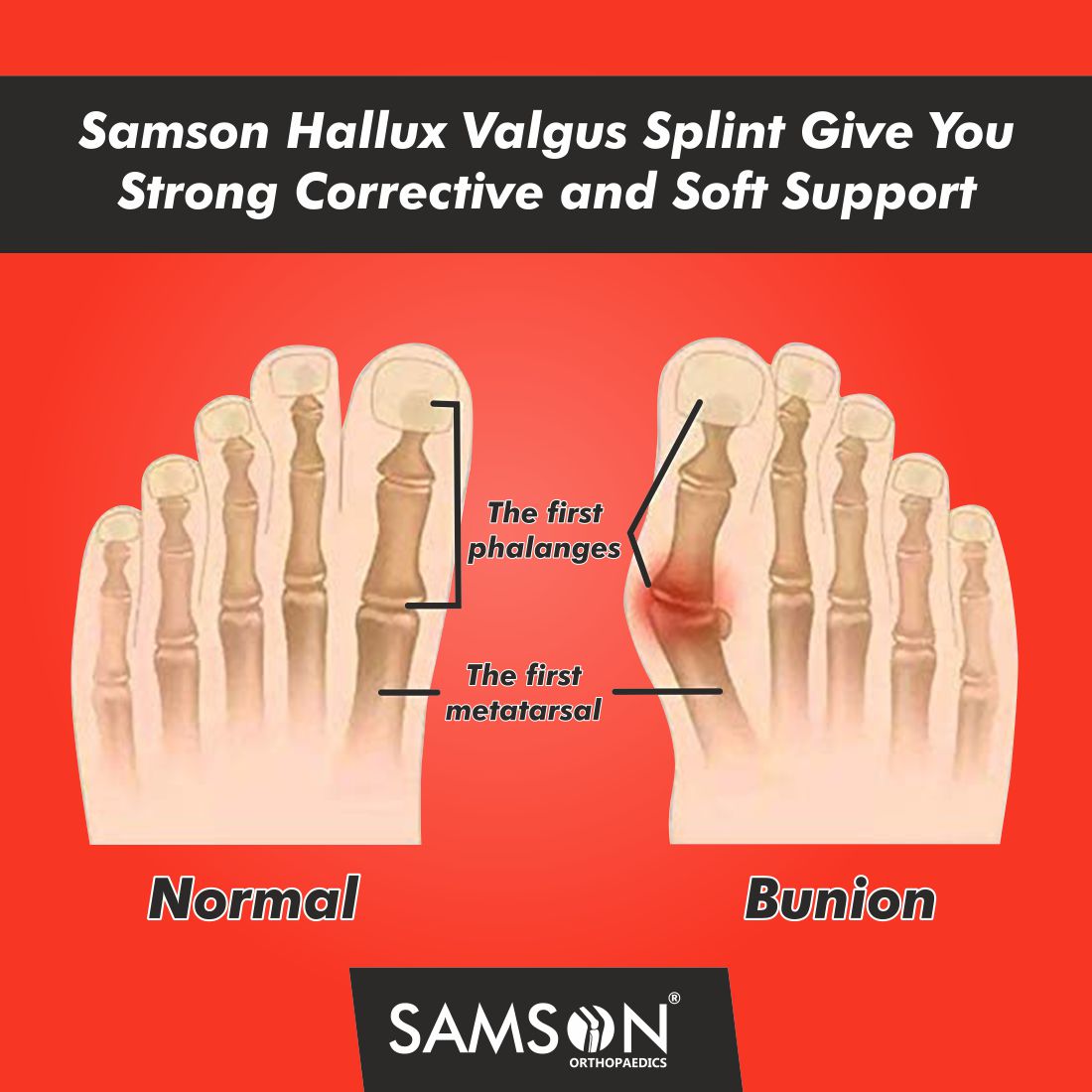 Hallux Valgus Splint